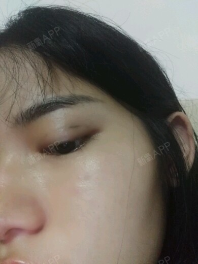 还有几天快25天了就右眼眼尾处有问题前几_圈子-新氧美容整形