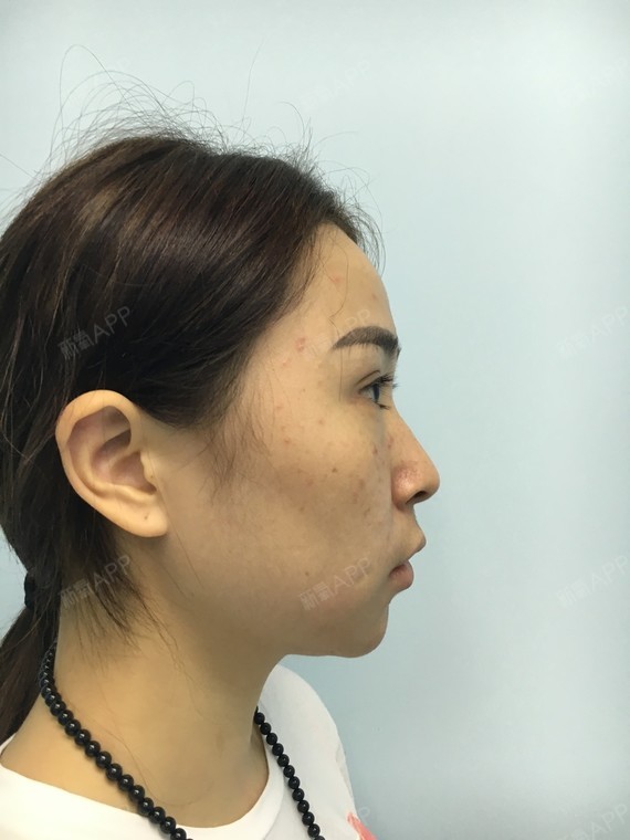 两个月了,现在的下巴是越来越自然了,感觉跟自己长的_圈子-新氧美容