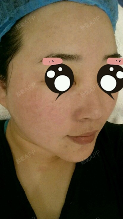 我是典型的敏感肌,遇冷遇热都会闹个大红脸,皮肤时不_圈子-新氧美容