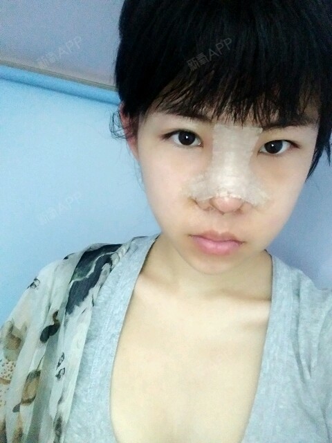 手术延长鼻小柱好不好_效果图_兔23手术延长鼻小柱术后第4天_新氧美容