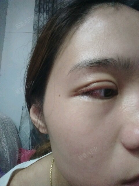 今天是埋线双眼皮地4天了,还是很肿,眼皮淤紫的厉害_圈子-新氧美容