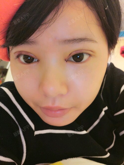 开内眼角好不好_效果图_bother开内眼角术后第7天_新氧美容整形
