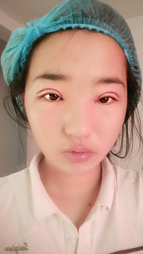 感觉右眼角开大了