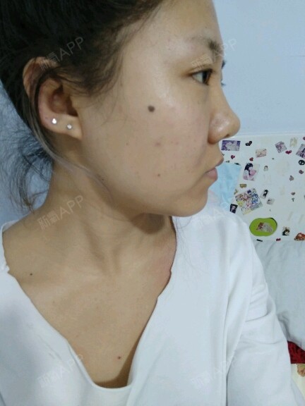 内双后来贴双眼皮贴,眼睛变成双眼皮但变成一大一小眼,鼻子塌,葱头鼻