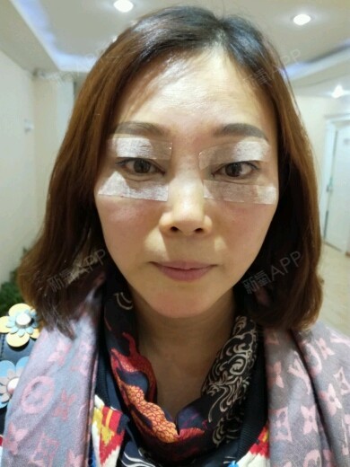 潼话自体脂肪丰泪沟术后第天美丽日记_新氧整形
