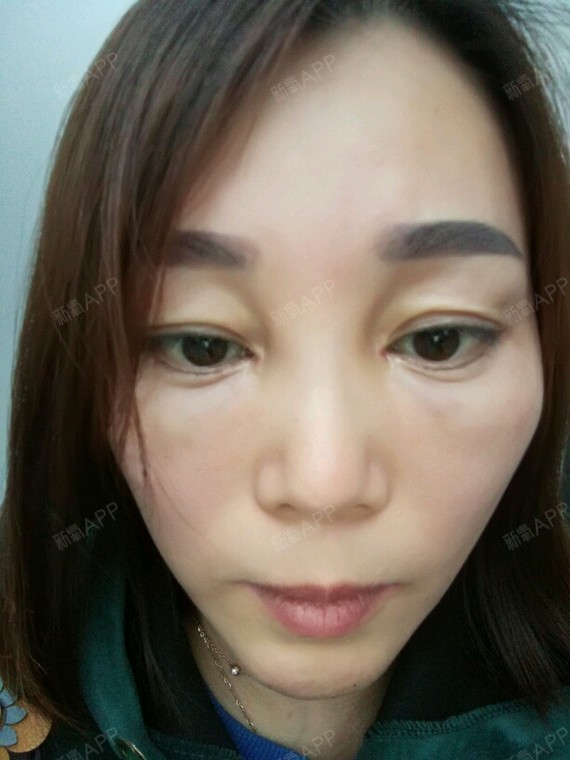 通过新氧消费方案查看自体脂肪丰泪沟手术无明显痛感违法和不良信息