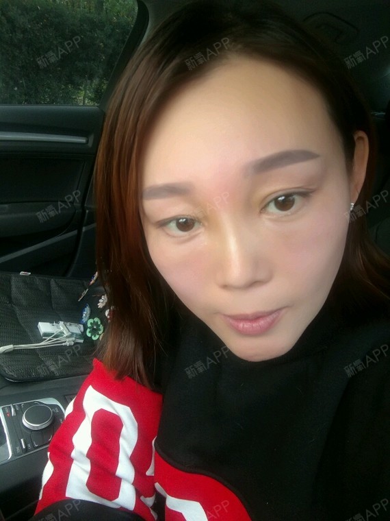 上眼窝自体脂肪填充今天是第十天了,脂肪填充的很满,_圈子-新氧美容