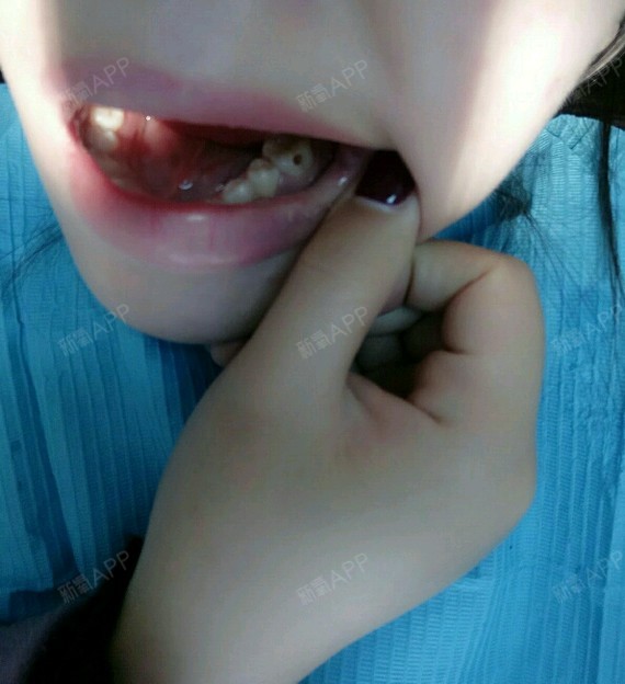 小可爱balala超声波洗牙第0天美丽日记