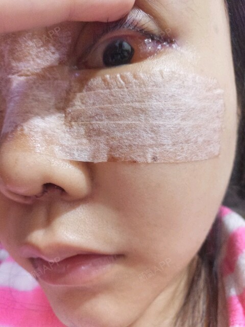 第7天了,开外眼角的结膜水肿越来越严重了,问了医院