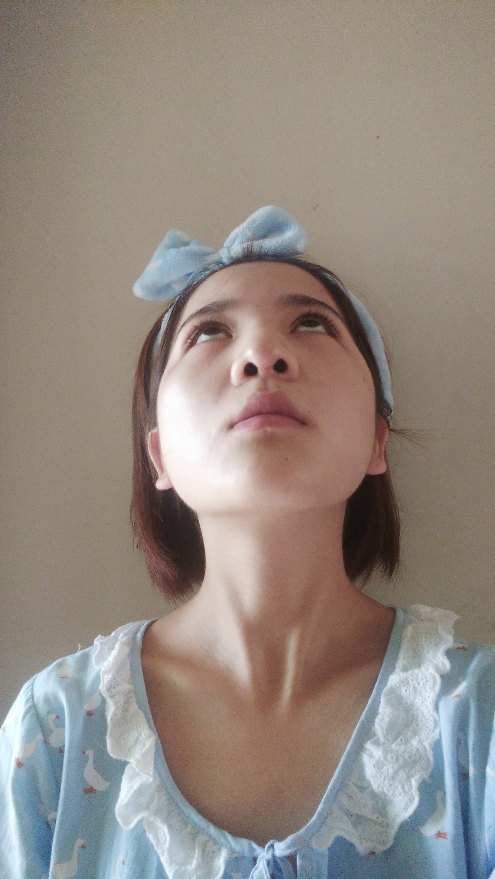 夕溪的美丽日记"12.11"自体软骨垫鼻尖_新氧整形