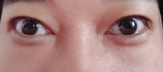 我内眼角来了好多年,开的太大了,眼睛经常干涩,容易_圈子-新氧美容