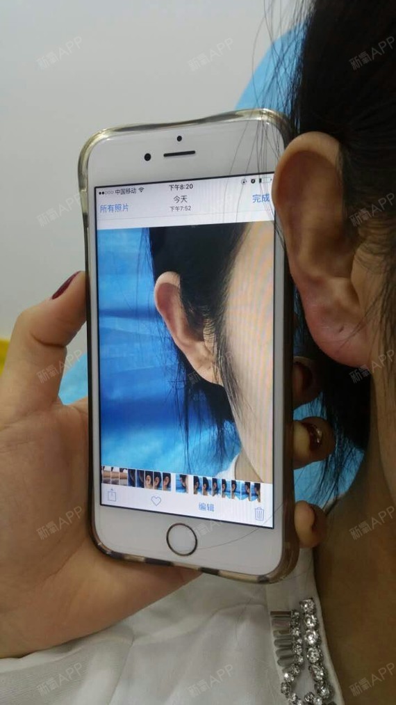 最近一直有点忙,上次玻尿酸丰耳垂一直没能和大家分享_圈子-新氧美容