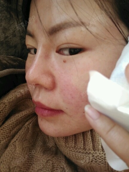 玻尿酸注射隆鼻第一天