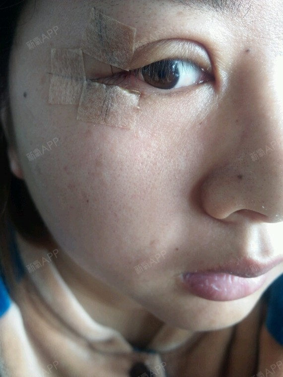 眼角好疼眨眼睛就疼