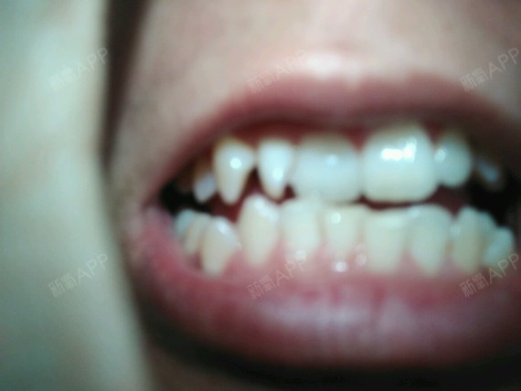 牙齿不整齐,有龅牙,虎牙,矫正大概要多少