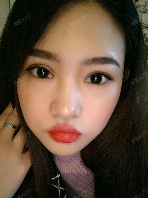 切开双眼皮好不好_效果图_告别小眼睛切开双眼皮术后第26天_新氧美容