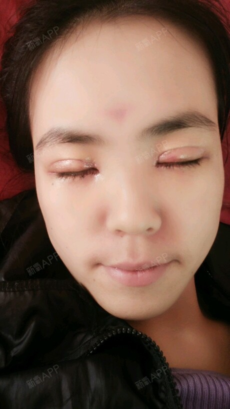 长春红星医院芭比翘睫毛双眼皮,开眼角术后4天效果给_圈子-新氧美容