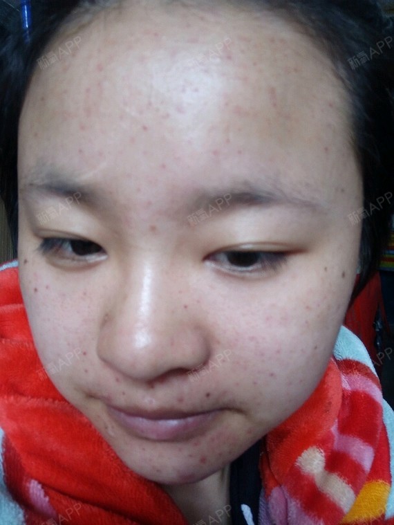 第一次打这种水光补水针眼超级大简直就是在毁容请问这真_圈子-新氧