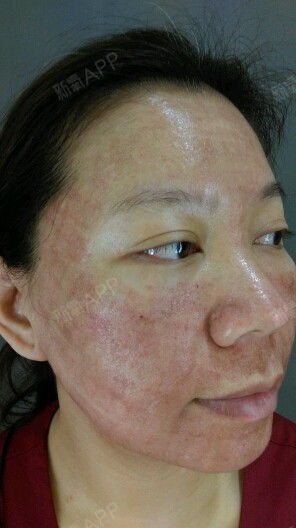 没有意外的,脸部皮肤开始结痂了一整个黑的廷匀称的呦_圈子-新氧美容