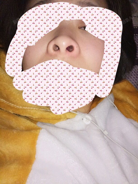 鼻孔也很大,我只想做个缩鼻翼,能改善多少,如果没啥用的话,我