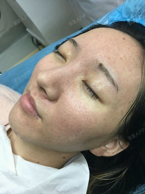 水光针好不好_效果图_s呀s水光针术后第8天_新氧美容整形