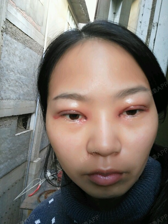 切开双眼皮开眼角去皮去脂提肌手术第一天