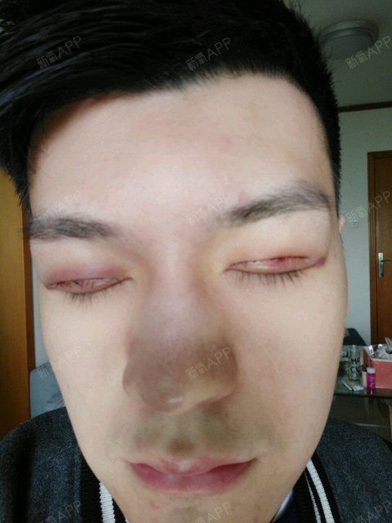 广州嘉悦@,双眼皮手术四天啦,早上起来感觉要肿一些,早上起来先拿
