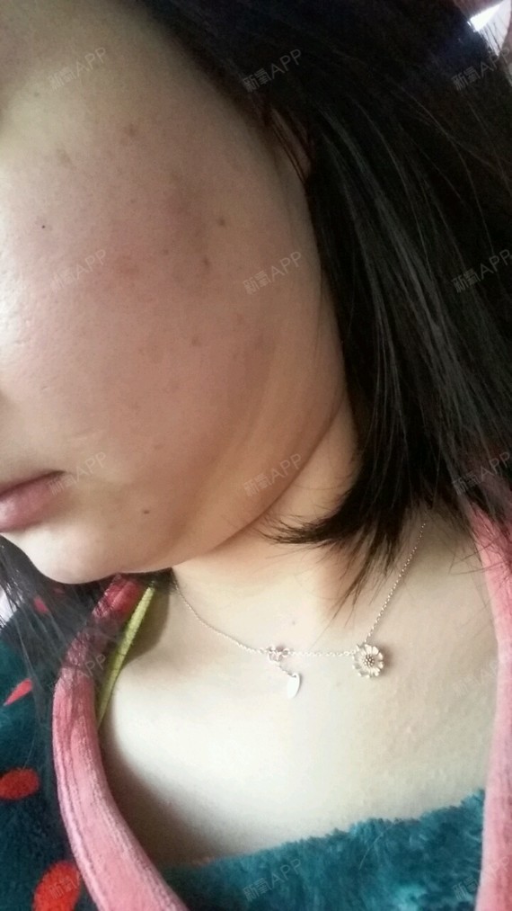 面部吸脂后下颌处出现皱纹怎么办,吸脂有半年多了,没_圈子-新氧美容