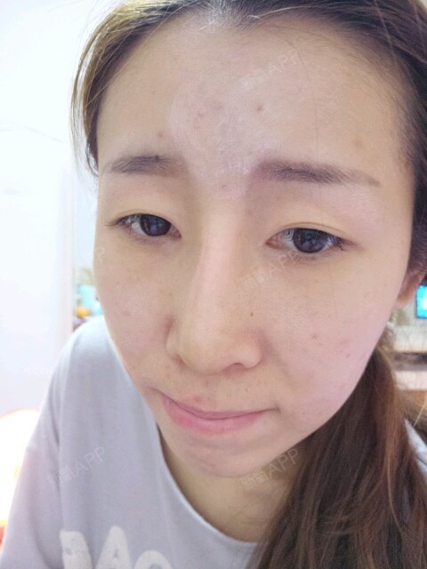 膨体隆鼻第八天,鼻背有点发红,好担心