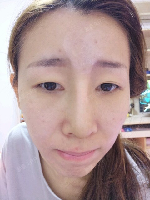 膨体隆鼻第八天,鼻背有点发红,好担心