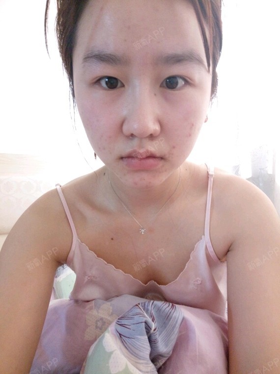 报名字体脂肪隆胸上海蓉城医疗美容医院胸a.