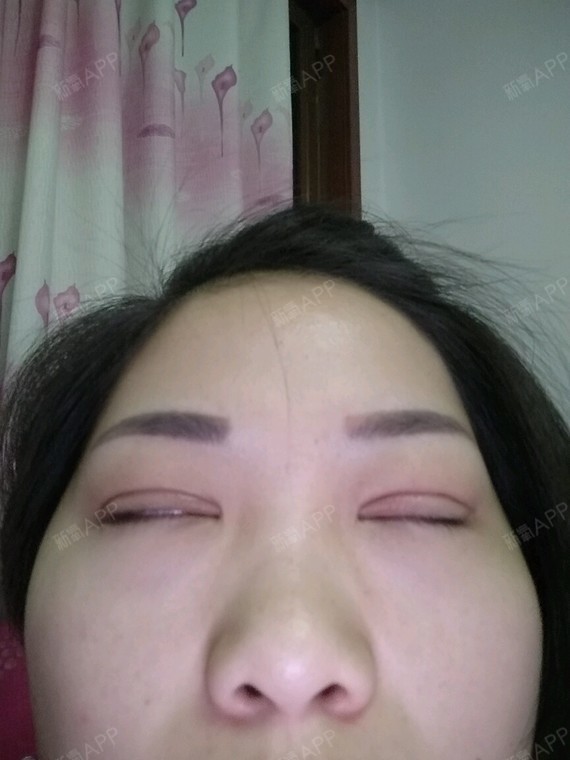 我做纳米无痕双眼皮有13天了,现在恢复成这样,是不_圈子-新氧美容整形