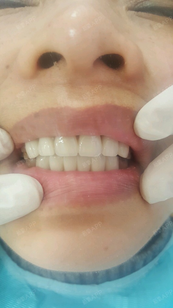 二氧化锆全瓷牙