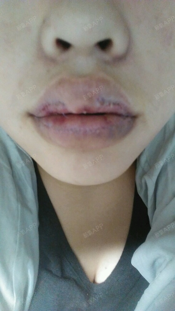 通过新氧消费方案查看厚唇改薄手术无明显痛感唇型美化机构查看重庆