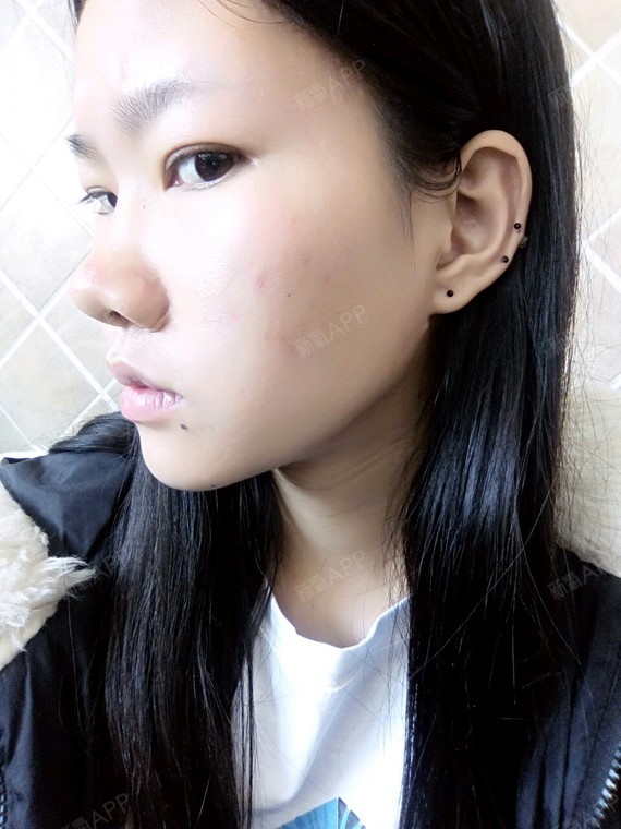 我鼻子是蒜头鼻,又大又翘,需要做些什么项目