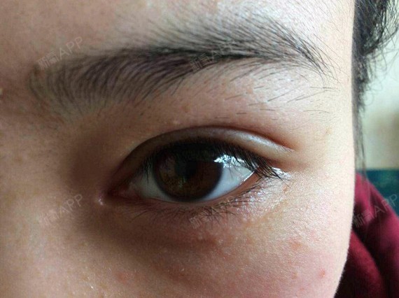 眼睛一大一小略明显