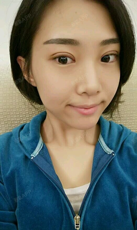 姝琳定点双眼皮第6天美丽日记