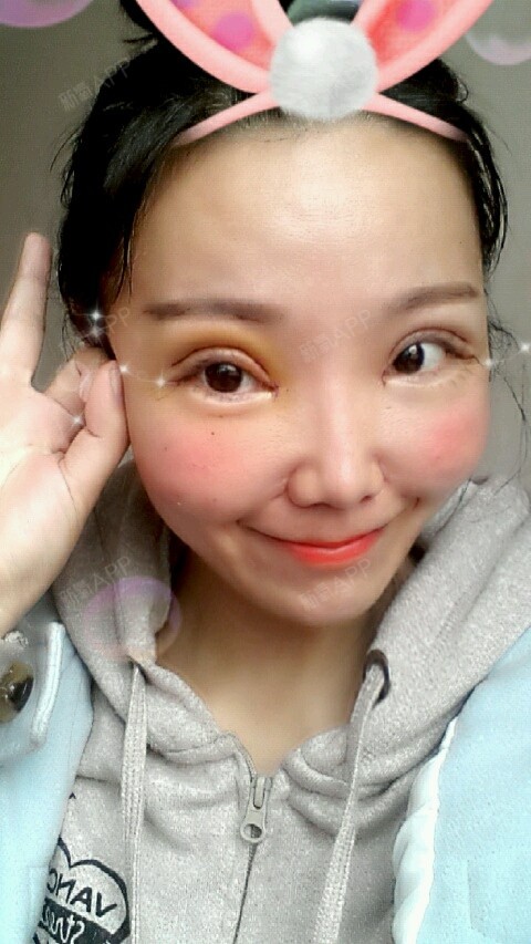 切开双眼皮好不好_效果图_塔塔儿切开双眼皮术后第5天_新氧美容整形