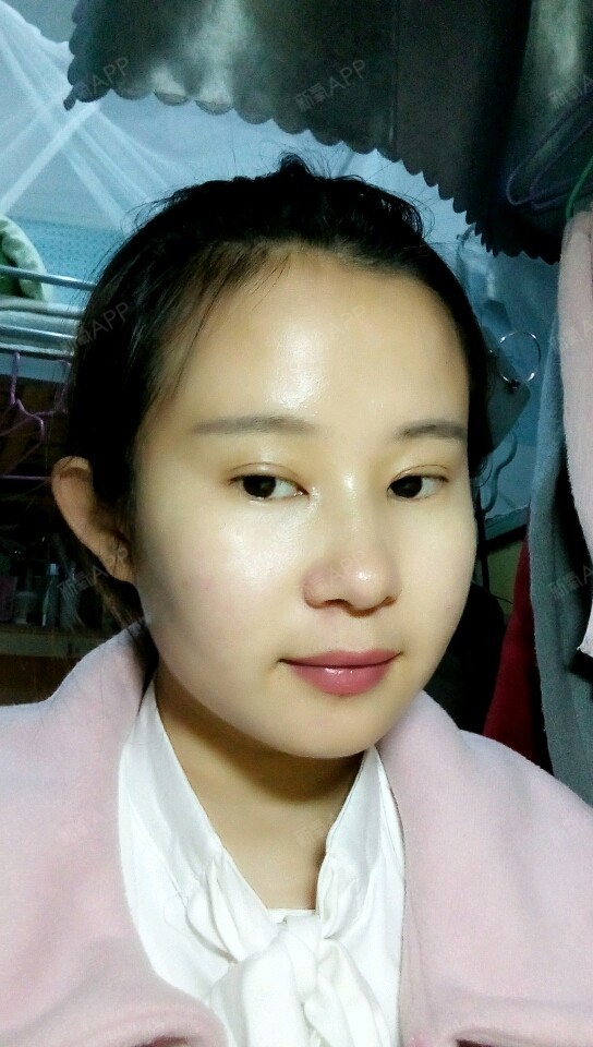 今天是开眼角手术一个月了,和双眼皮手术一起做的,感_圈子-新氧美容