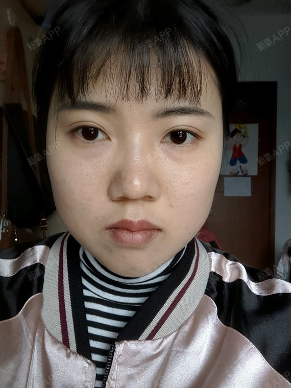 终于鼓起勇气去打玻尿酸下巴从小到大没有下巴咬肌超级_圈子-新氧美容