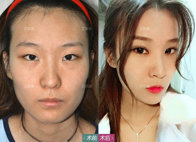 眉骨生花切开双眼皮第3天美丽日记-新氧美容整形