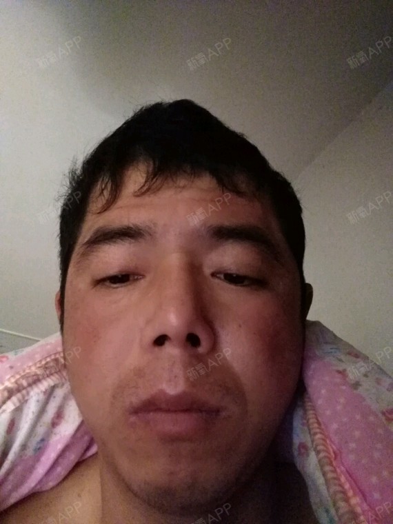 脸部痘痕痘印,还毛孔粗大