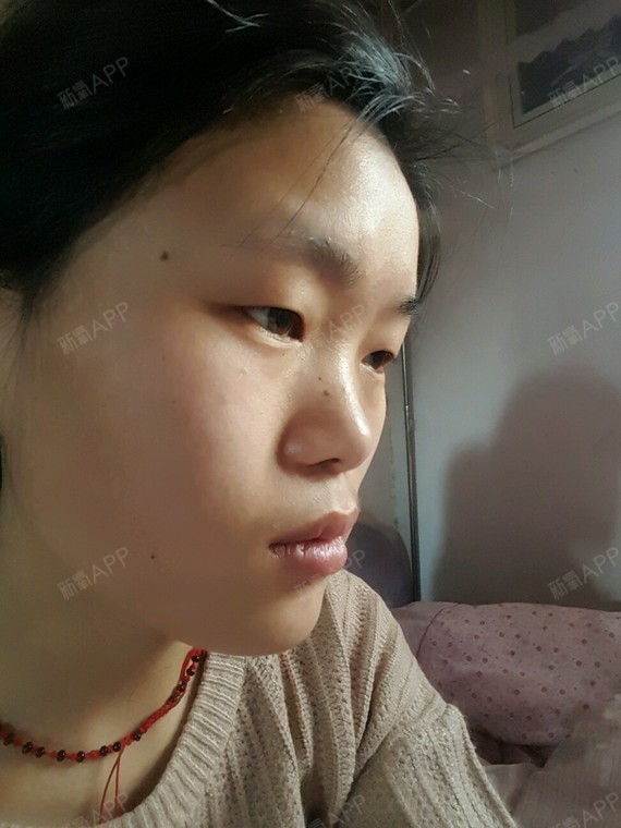 天生脸部扁平,鼻子扁平,眼睛单眼皮还小,希望在此可_圈子-新氧美容