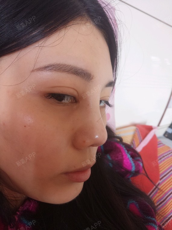 请不要吐槽我凹陷的跟葫芦娃似的,做完两个星期了吧,_圈子-新氧美容