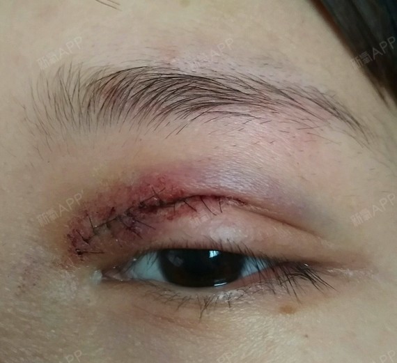 双眼皮缝合不好太明显的话后期恢复也不怎么样