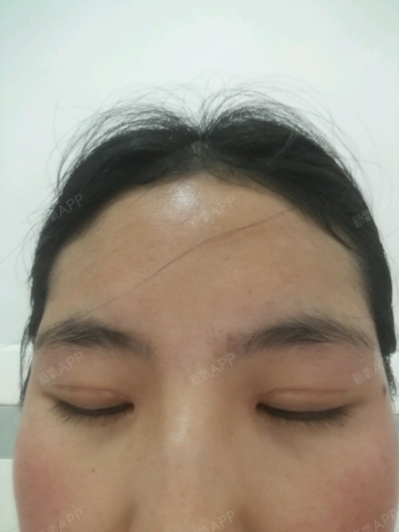 我的双眼皮已经做了七个月了,还是有肉条,没有完全消肿,我很担心,这