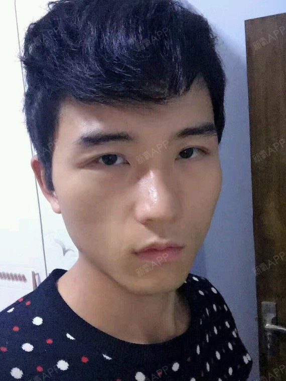 双眼皮半年多了,还不错,我觉着这种自然带点内双的还_圈子-新氧美容