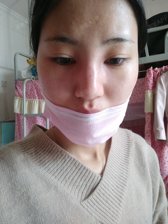 鼻子打了一针玻尿酸,算是残了吗?