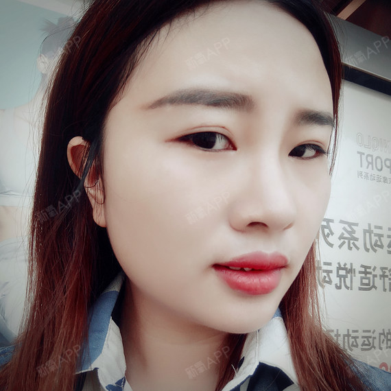 线雕的第三天了,鼻子还是有些肿,触摸鼻子时还是有点_圈子-新氧美容