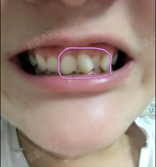 第一张图是磨完牙以后的样子,第二张图是戴了临时牙的_圈子-新氧美容